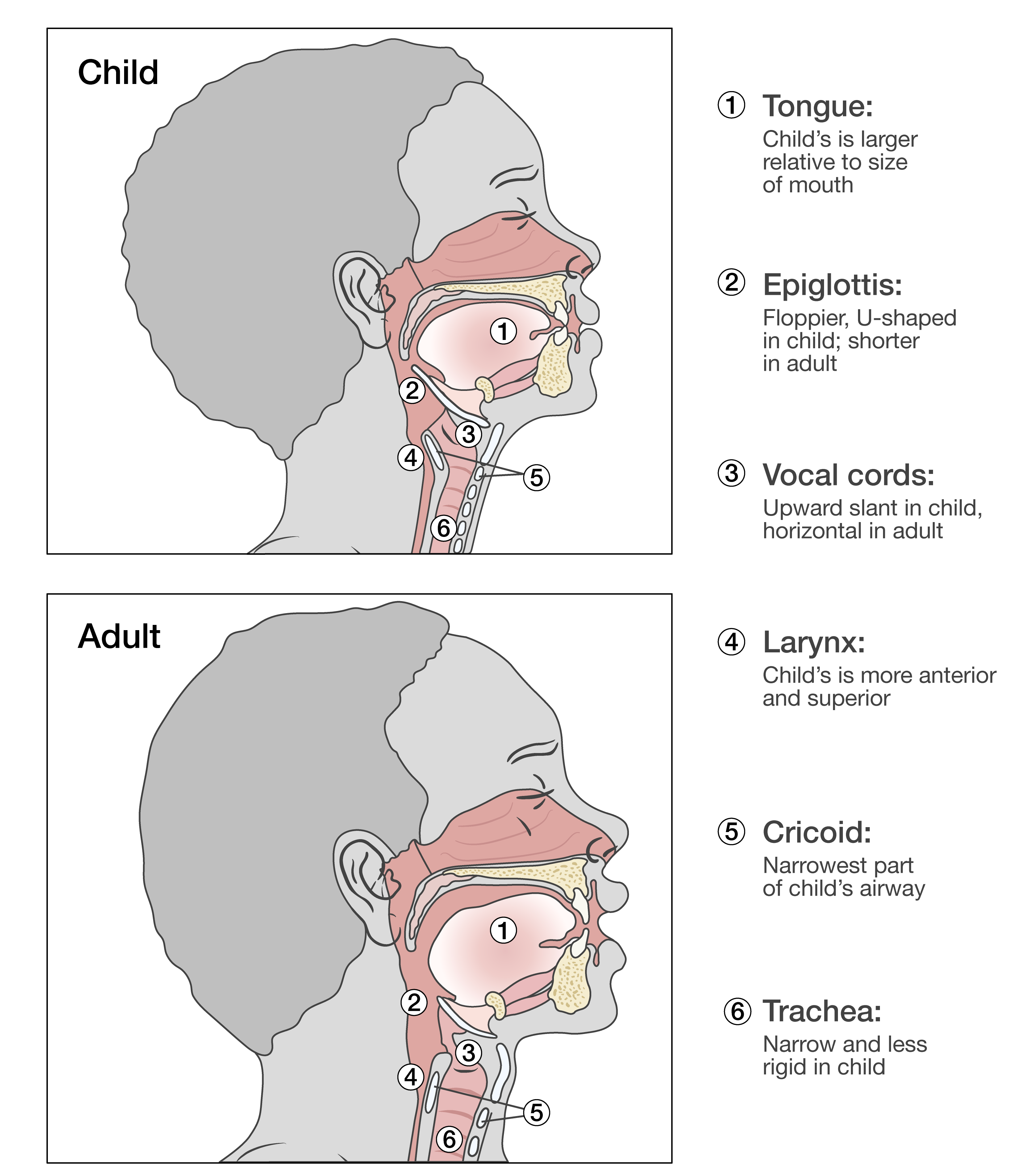 Illustrated cross-sectional comparison of adult vs pediatric upper airway showing relative sizing of tongue, larynx position, and epiglottis.