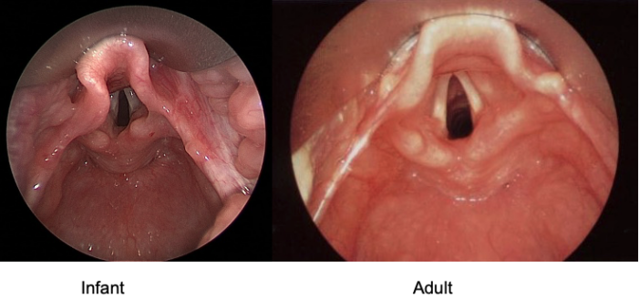 Side-by-side videolaryngoscope view of an adult and a pediatric glottis, showing the floppier U-shaped epiglottis and more anterior cords in the child.
