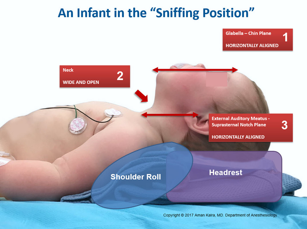 Infant in sniffing position with a roll under the shoulders, not the head, to compensate for a large occiput.